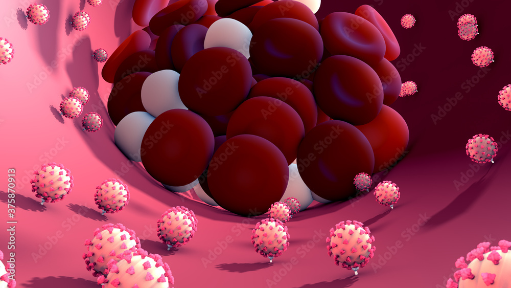 Coronavirus or virus causing blood clots to form in the blood system
