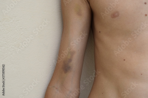 Large bruises and abrasions on the boy's arm.