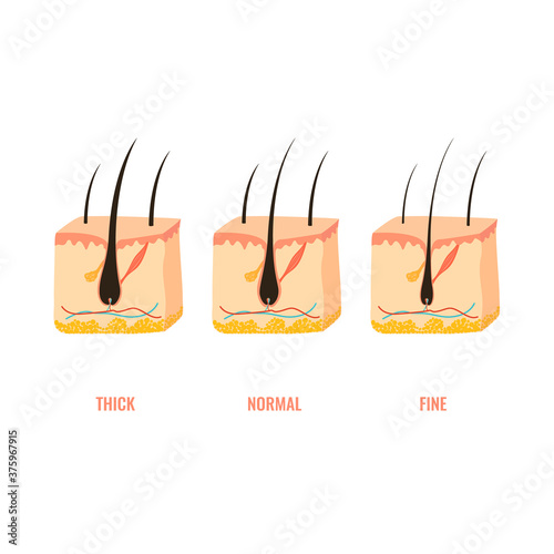 Hair thickness types classification set. Skin cross-section with fine, normal, thick strands. Anatomical structure scheme. Cartoon vector illustration. 