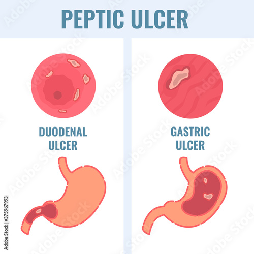 Peptic ulcer stomach disease infographic poster. Endoscopic image of stomach with duodenal and gastric PUD. Digestive tract organ disorder. Health care and medical concept. Vector illustration.  photo