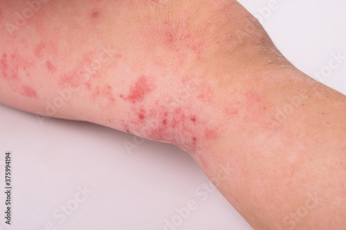 rash on a child leg isolated on white background  redness  allergic reaction  dermatitis symptom