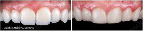 10 unit press ceramic crowns and veneers