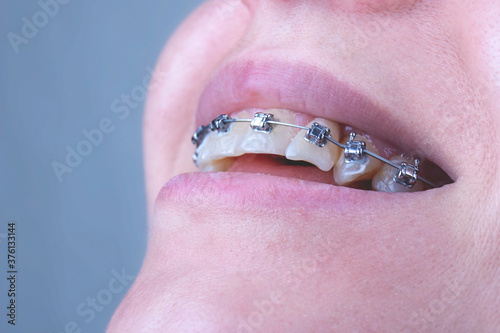 Beautiful of teeth with braces. Dental care photo. Young woman smile with orthodontic accessories. Orthodontics treatment.