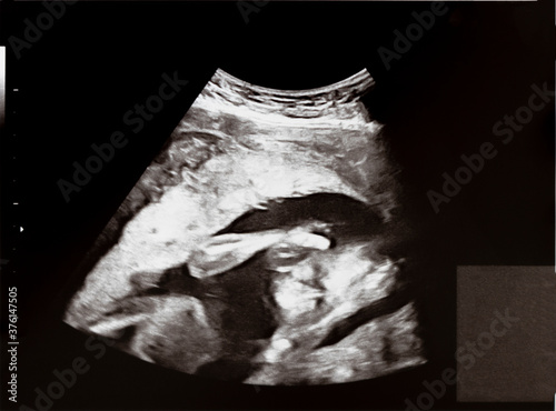妊娠して20週目の胎児のエコー写真