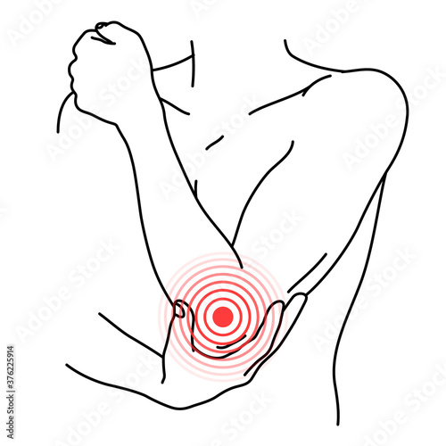 Elbow pain location. Bursitis of arm joint, dislocated, sprain, arthritis, arthrosis, epicondylitis.