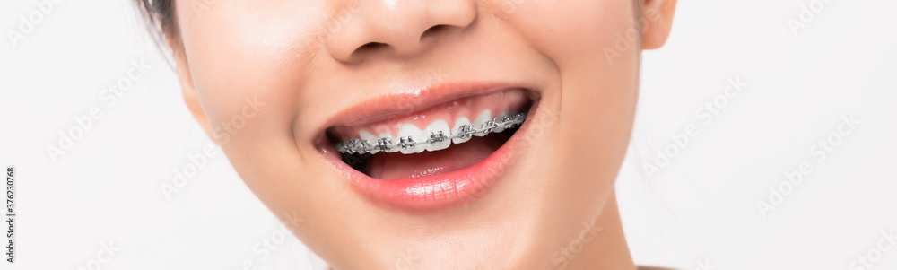 Obraz premium Face of a young smiling asian woman with braces on teeth, Orthodontic Treatment.