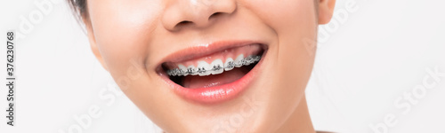 Face of a young smiling asian woman with braces on teeth, Orthodontic Treatment.