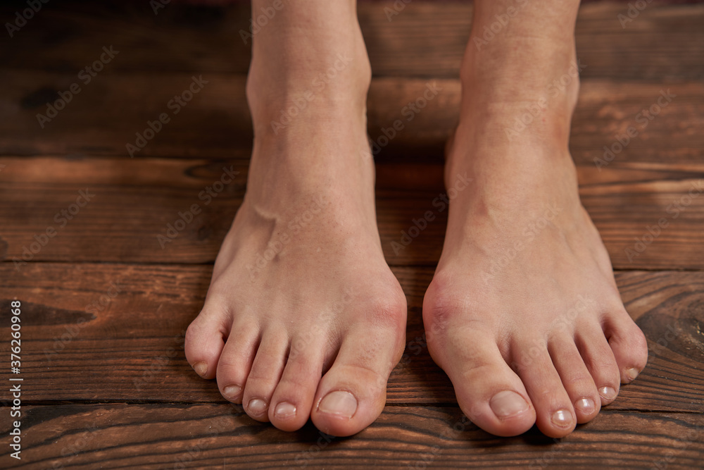 Hllux Valgus on female legs close up on wooden background Hllux Valgus on female legs close up on wooden background