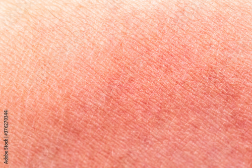 Sunburn skin as a texture or background. Selective focus. Extreme macro