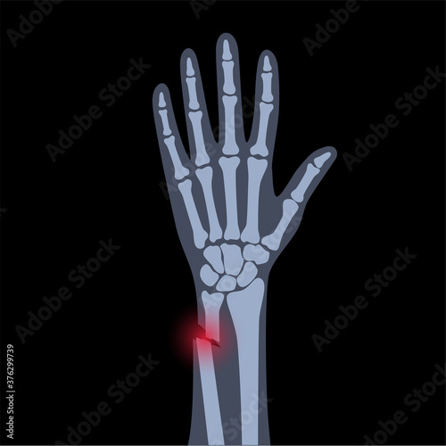 Fracture x ray concept