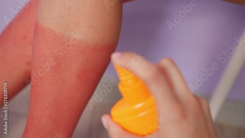 Applying of sunscreen cream on red sunburned skin, closeup