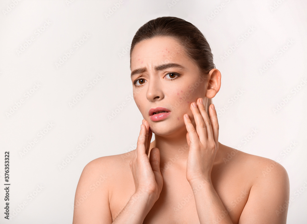 Young woman with acne problem on white background