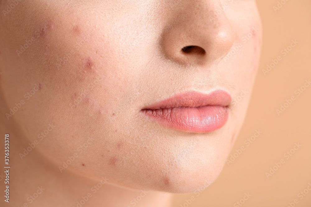 Young woman with acne problem on color background, closeup Young woman with acne problem on color background, closeup