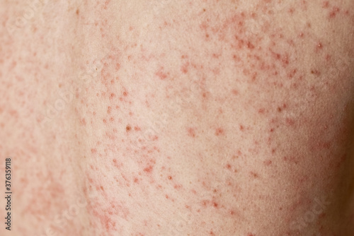 Allergic rash on skin. Woman with dermatology problem on back skin