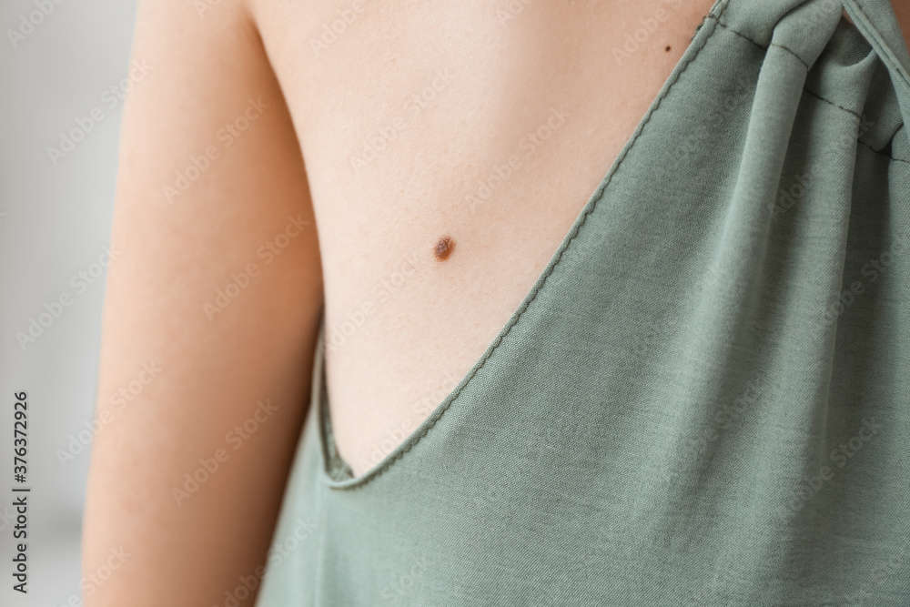 Woman with moles at dermatologist's office, closeup