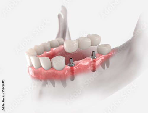 3d illustration of gums with dental bridge, supported by two implants