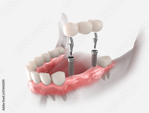 Konstfotografi 3d illustration of gums with dental bridge, supported by two implants