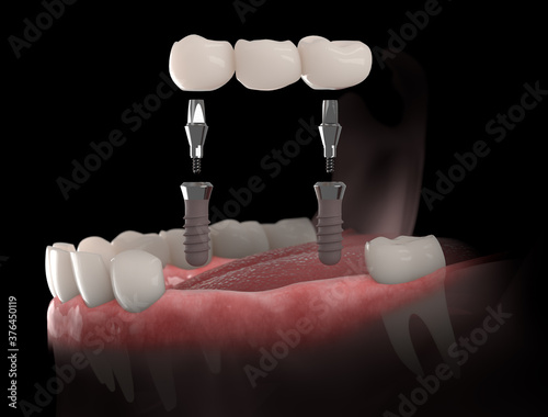 3d illustration of gums with dental bridge, supported by two implants. Black background.