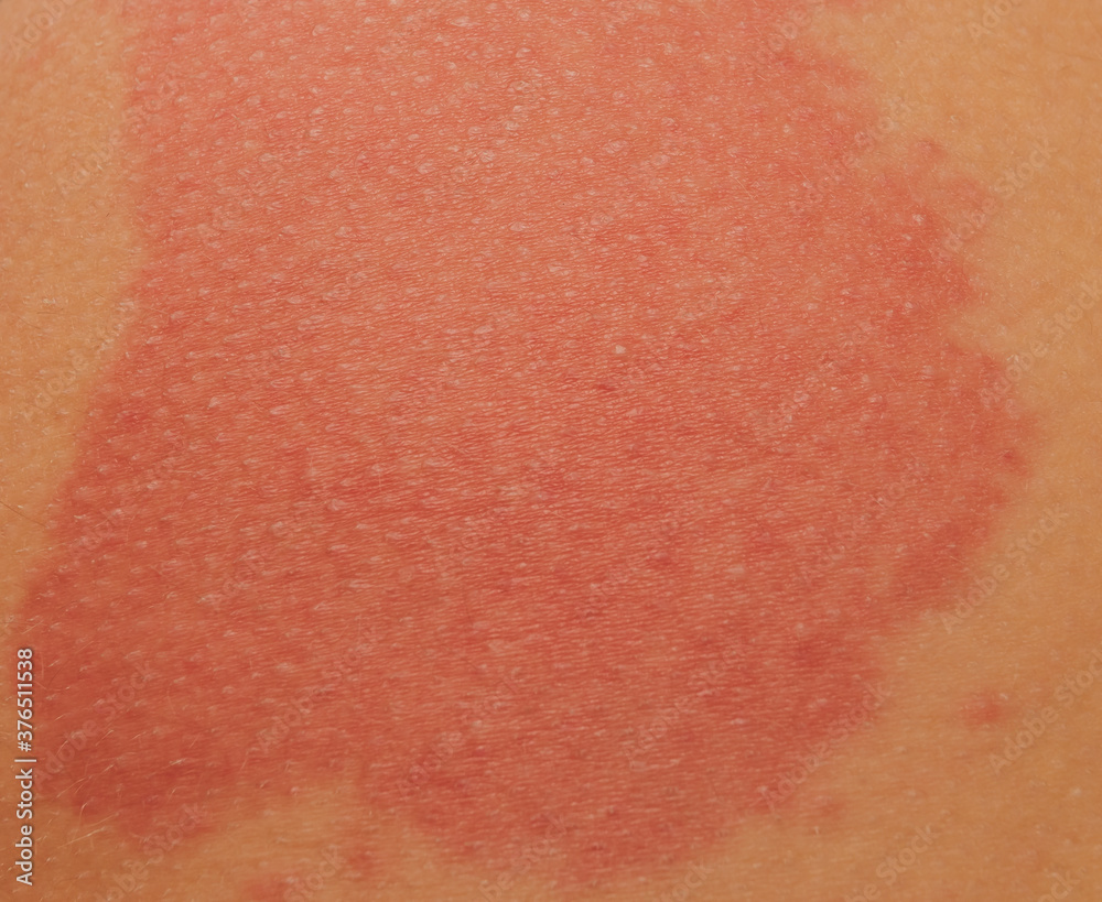 Urticaria or hives on the back, on the shoulder red rashes, itchy bumps