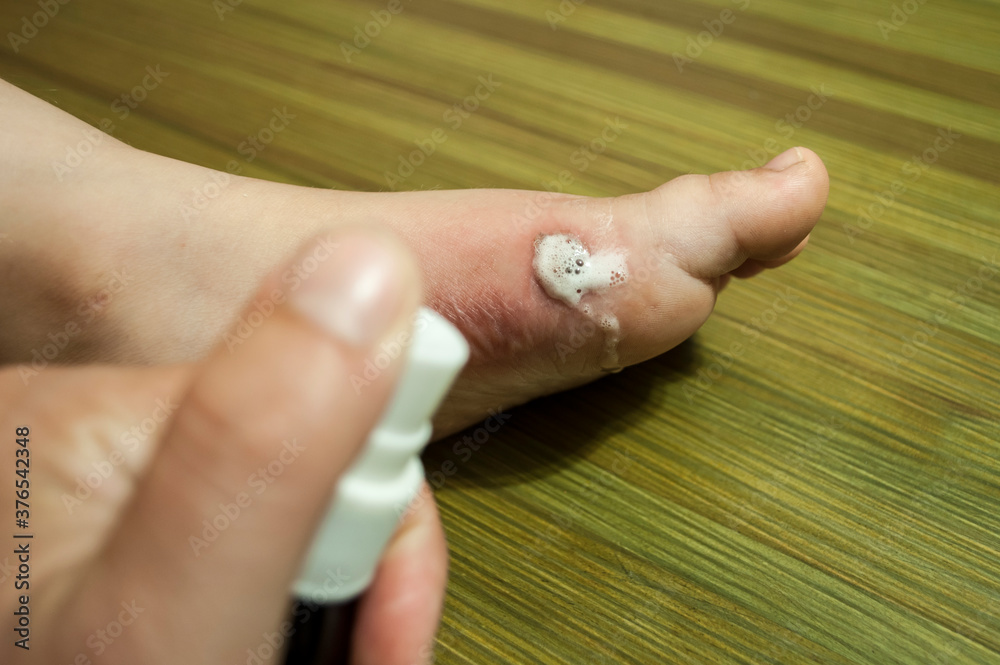 Burn on the foot of a child. The burns blister burst, wound healing