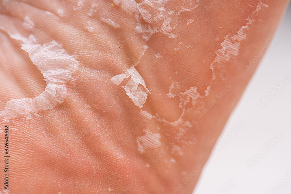 Fototapeta premium Skin peeling on the sole of a foot.