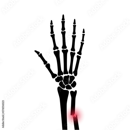 Fracture x ray concept