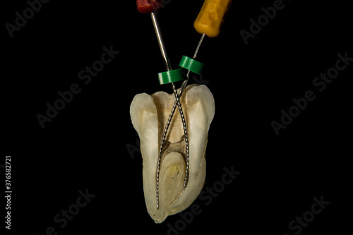 Molar file endodontics