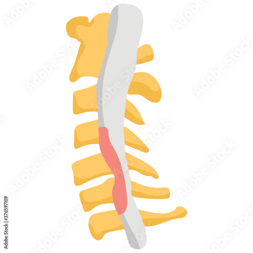 Spinal Stenosis
