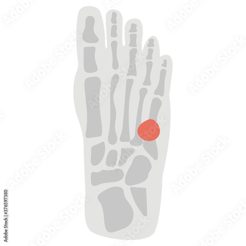 Foot Fracture
