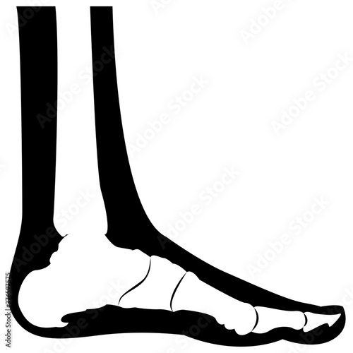 Heel Spur