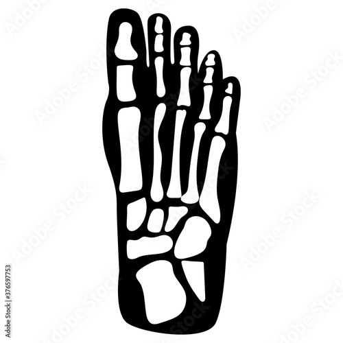 Foot Fracture