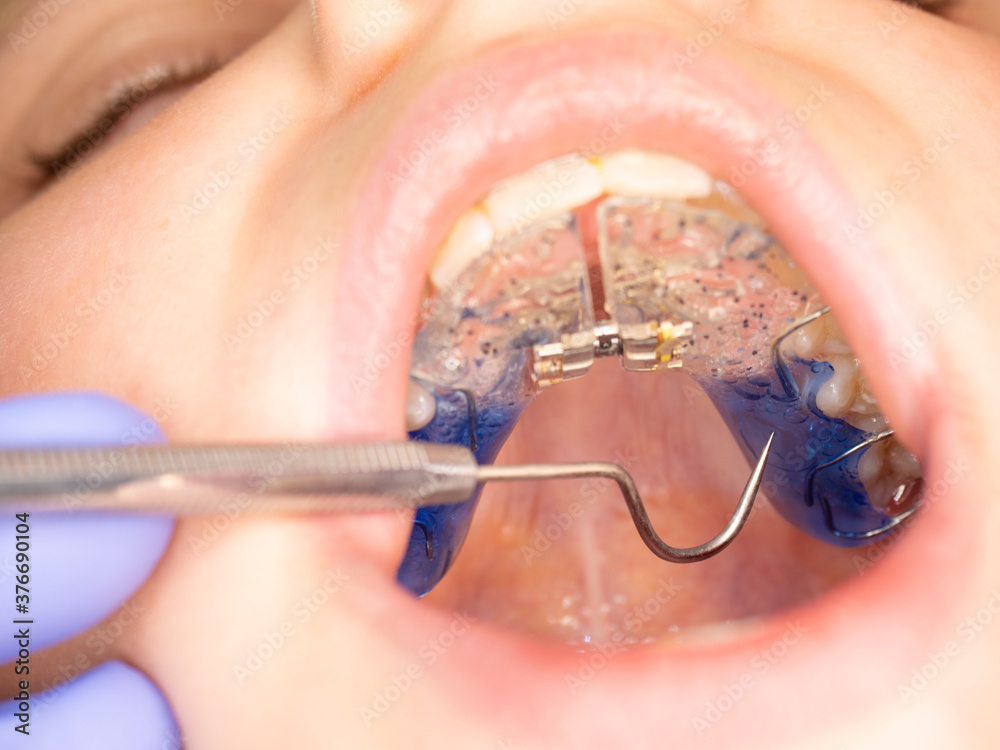 Check distance screw in expanding braces Check distance screw in expanding braces