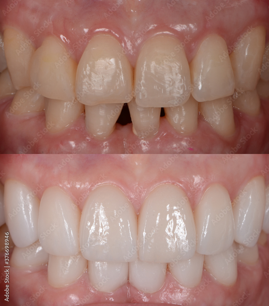 Before and after of  covering natural teeth with ceramic veneers 