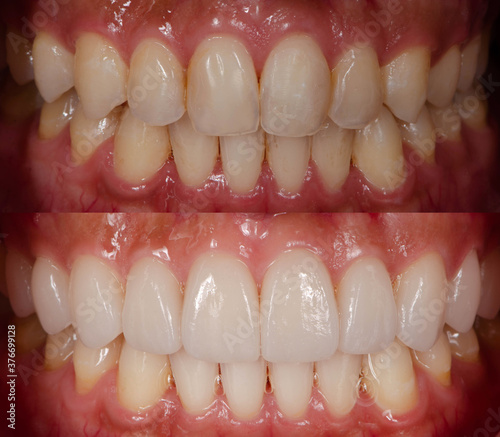 Before and after of covering natural teeth with ceramic veneers 