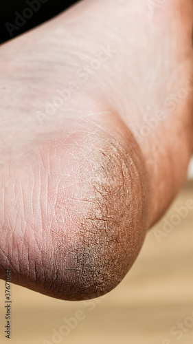 Man cracked heel. Dirt feet  cracked feet due to walking barefoot. 