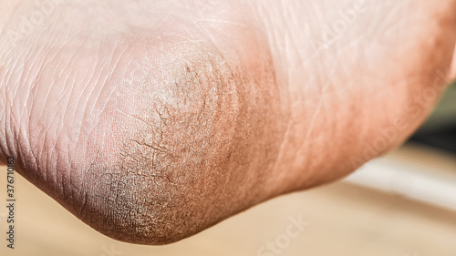 Man cracked heel. Dirt feet  cracked feet due to walking barefoot. 