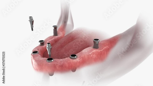 Restoration of mandible with 6 implants. 3D animation of installation dental prosthesis.