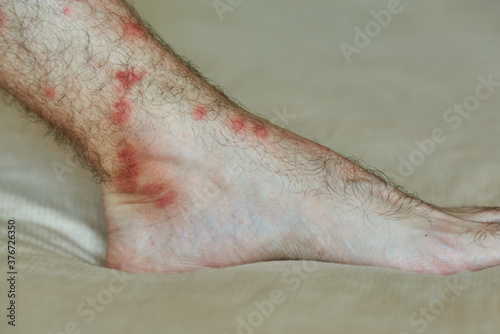 Male foot with many red spot and scar from insect bite.