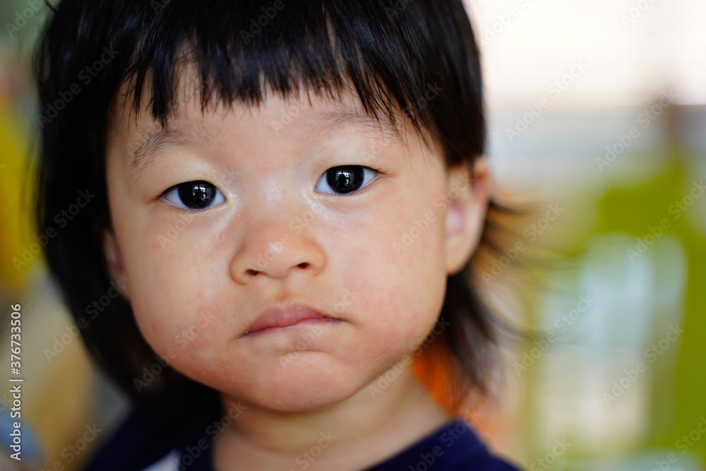 Pityriasis rosea appear scaly spot on baby face,Asian baby close up front portrait on soft blurred background. Pityriasis rosea appear scaly spot on baby face,Asian baby close up front portrait on soft blurred background.