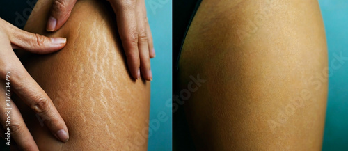 Before And After Photos Of Female Hip Stretch Marks On Woman's Legs