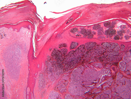 Microscope view of malignant melanoma photo