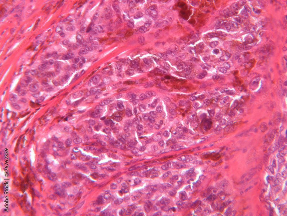 Microscope view of malignant melanoma Microscope view of malignant melanoma