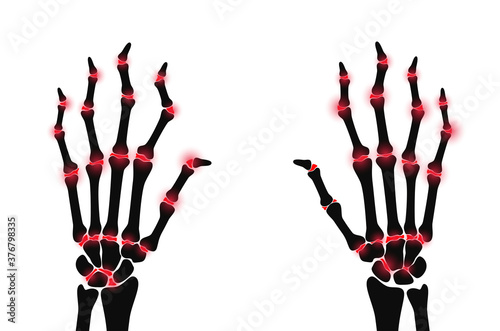 Arthrits x ray