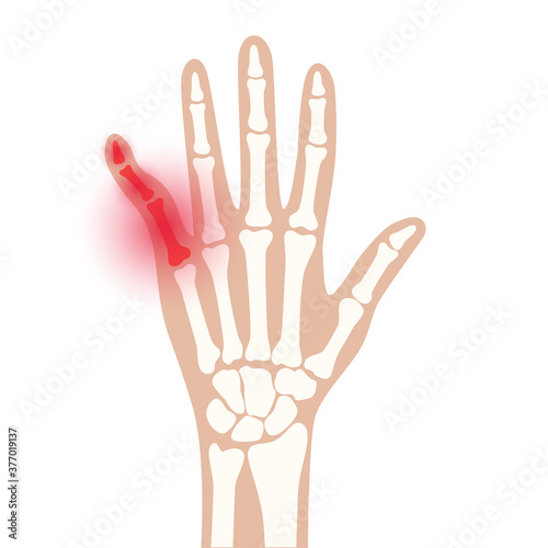 Arthrits x ray