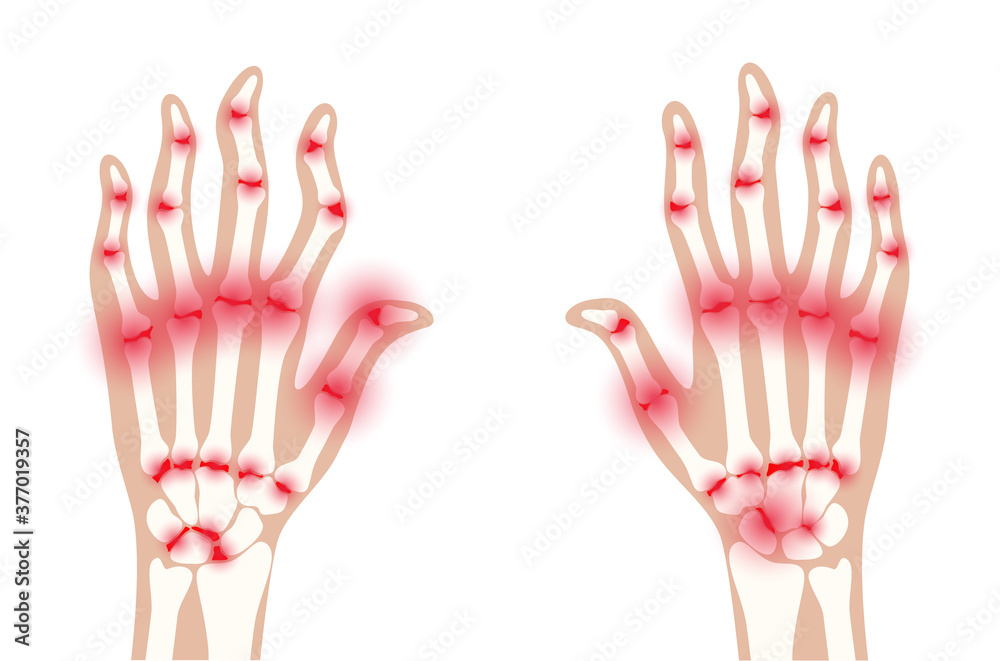 Obraz premium Arthrits x ray