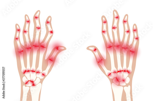 Arthrits x ray