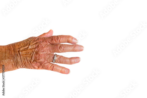 A brown hand with two silver rings of an elderly woman with Rheumatoid Arthritis disease on a white background.