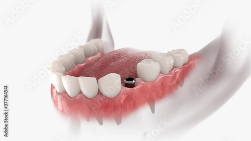 Instalation of dental crown, abutment and implant. 3D animation of human teeth and dentures on white background.