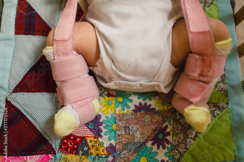 baby with hip and leg brace sleeps in crib photo