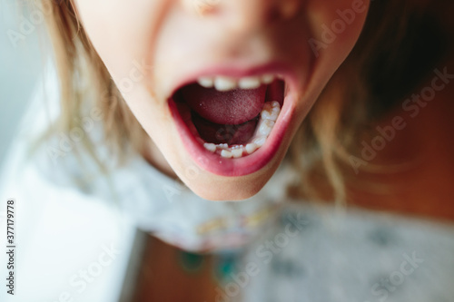 closeup of little kid with extra teeth in mouth photo